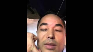 Threading technique