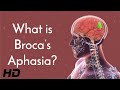 Broca&#39;s Aphasia and the Brain: What We Know and What We&#39;re Still Learning