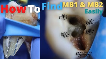 how to find mesiobuccal (mb1 and mb2) canals easily | maxillary first molar access opening