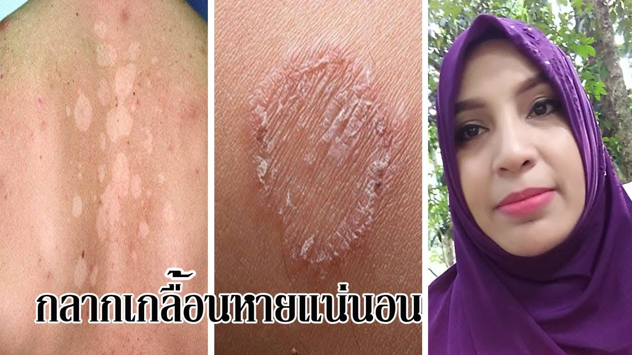 #แชร์ประสบการณ์ วิธีรักษากลากเกลื้อนให้หาย ด้วยธรรมชาติ | นูจิดาภา ... #แชร์ประสบการณ์ วิธีรักษากลากเกลื้อนให้หาย ด้วยธรรมชาติ | นูจิดาภา ...