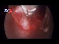 Rare Heart Surgery on five year girl turns successful in Guntur dist.