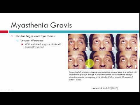 Myasthenia Gravis Clinical Characteristics