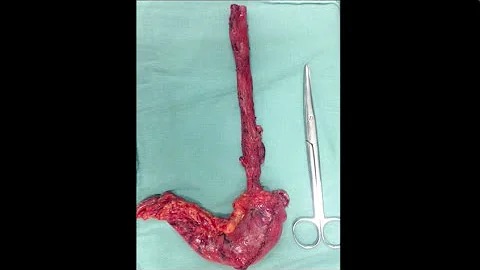 Como é realizada cirurgia de câncer no esôfago?