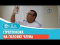 👉 Стрептококк на головке члена. Клинический случай №939