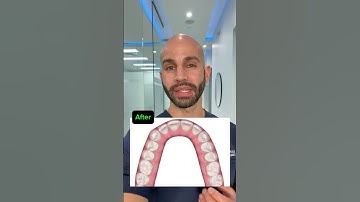 Invisalign to Close Spaces/Gaps and Open a Deep Overbite (2024)
