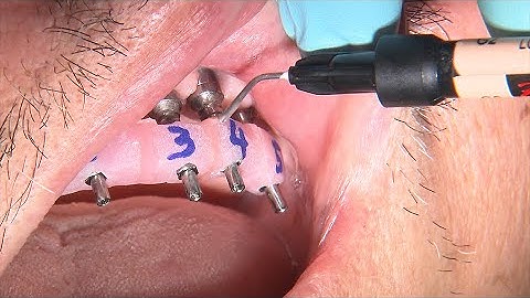 Chairside Live Episode 262: How to Fabricate an Implant Verification Jig