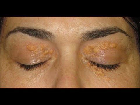 Video: Xanthelasma-oogleden - Behandeling, Verwijdering