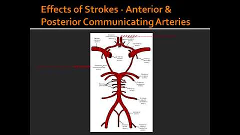 Effects of Strokes - Anterior & Posterior Communicating Arteries