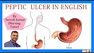 PEPTIC ULCER IN ENGLISH |  Gastric ulcer | Duodenal ulcer | esophageal ulcer | causes and prevention