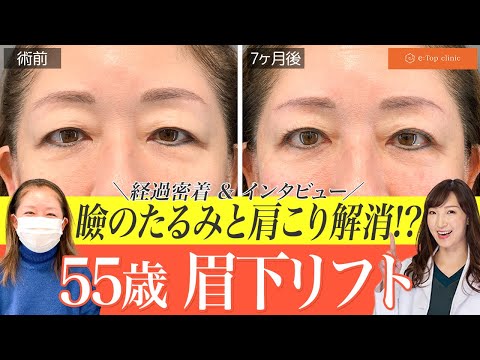 眉下リフトで見た目も機能も改善され一石三鳥のような満足感！