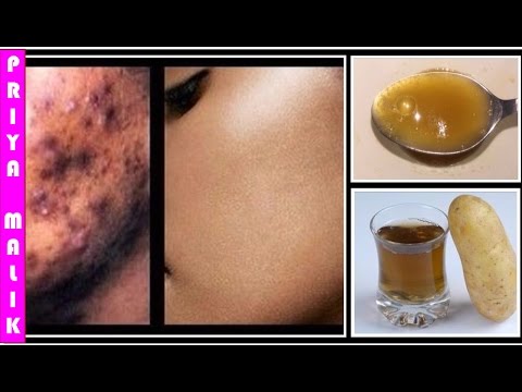 Remove Dark Spots, Black Spots, Acne Scars from Face in JUST  DAYS || Skin Whitening Home Remedy