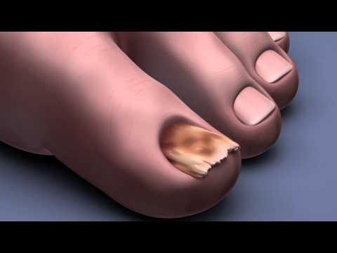 Видео: Черен нокът на ноктите: причини, лечения и други
