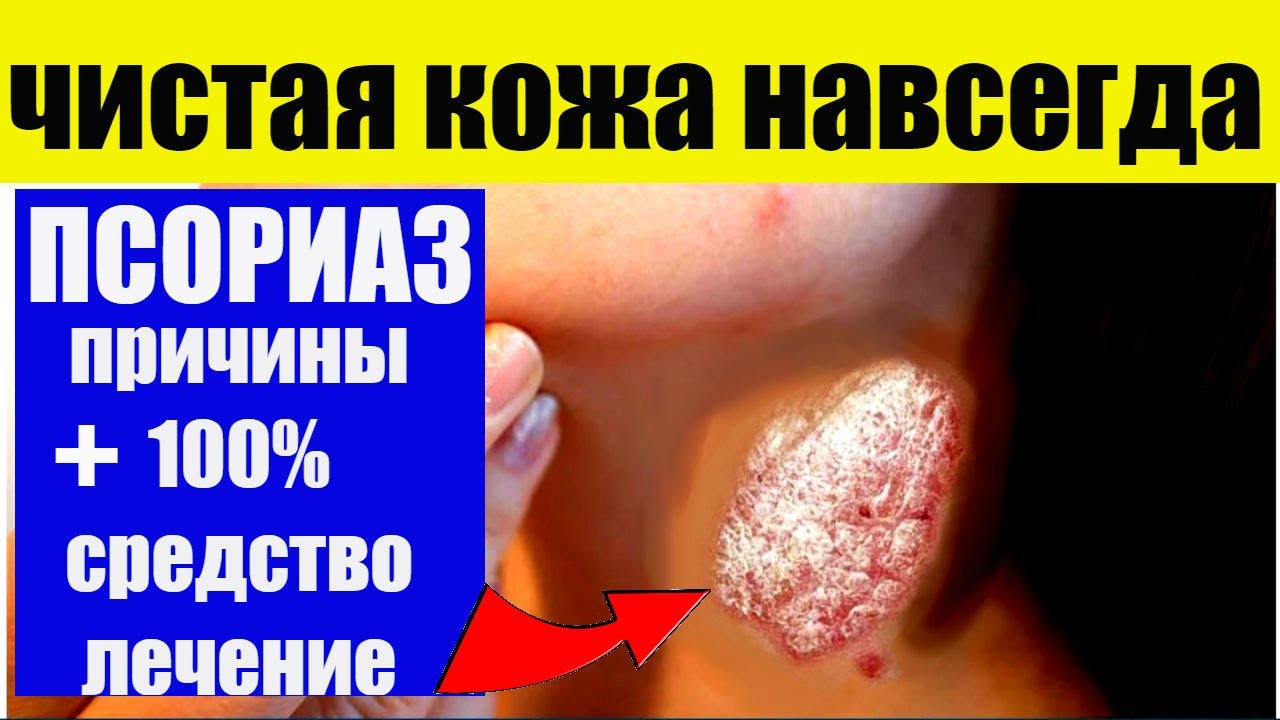 #Лечение ПСОРИАЗА , - вылечи #псориаз народными средствами #здоровье ...