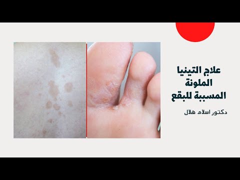 علاج التينيا الملونة   دكتور اسلام هلال