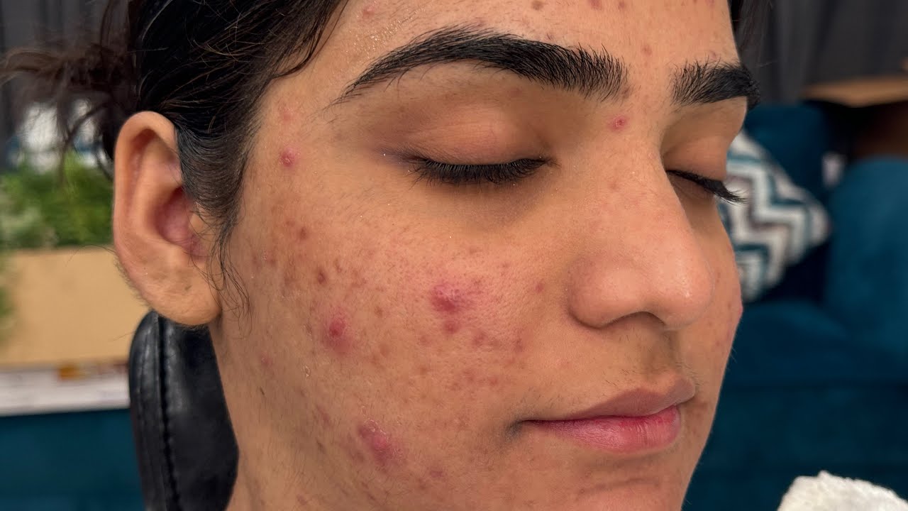 Live Makeup Class | How to  apply Makeup if you have Acne prone Skin without Concealer & Primer |