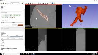 DICOM to STL Conversion Tutorial with Threshold Editor