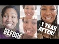 Invisalign 1 year update #1 | How to fake teeth with wax in your invisalign