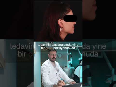 VAKA – Diş Çekimi Korkusundan Mükemmel Gülüşe: Bir Ortodonti Başarısı