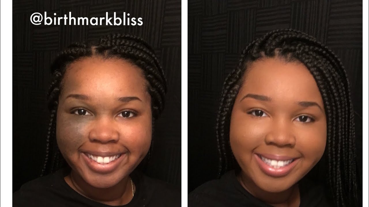 Birthmark Coverage