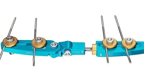 Anatomic and Dynamic Distal Radius External Fixator