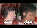  قصتي مع مرض الثعلبة   وكيف عالجتها