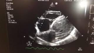 Left ventricular thrombus
