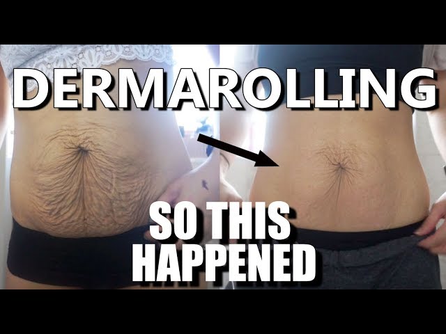 I Tried Dermarolling My Saggy Skin This Happened Astonishing Results Youtube