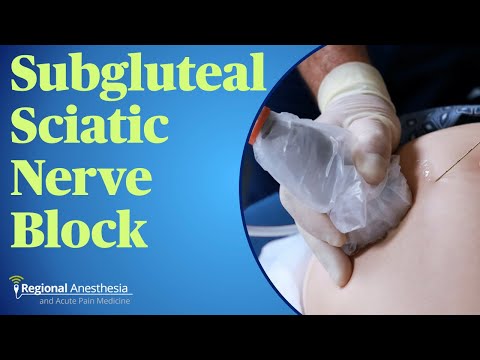 Subgluteal Sciatic Nerve Block