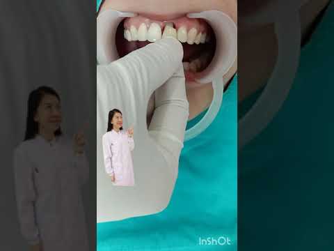 วีดีโอ: วิธีหลีกเลี่ยงปัญหาครอบฟัน 13 ขั้นตอน (พร้อมรูปภาพ)