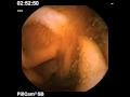 Capsule endoscopy celiac.mpg