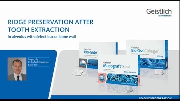 Ridge Preservation after Tooth Extraction - Defect Buccal Bone Wall - Dr. Raffaele Cavalcanti