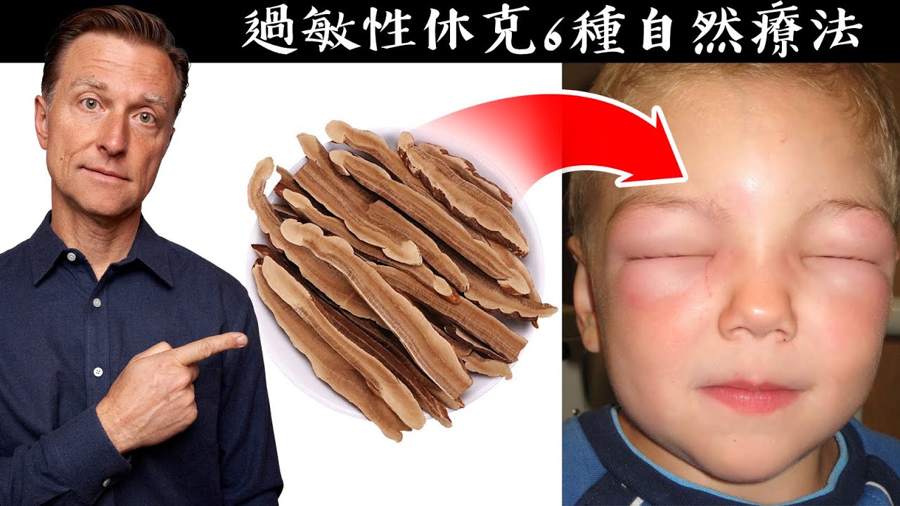 過敏性休克的6種自然療法,柏格醫生 Dr Berg