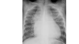 Total Anomalous Pulmonary  Venous Return- TAPVR