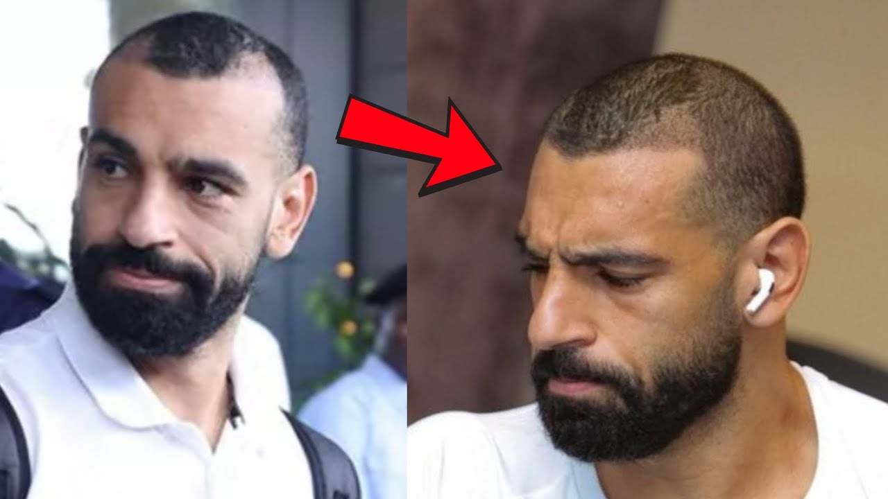 Mo Salah’s Hair Transplant after 7 Months! My Review