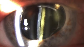 Lens exchanged for severe Glistenings by Steven G. Safran MD
