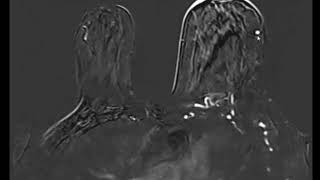 Meme Ödemi̇ne Neden Olan Medi̇asti̇nal Ki̇tle Meme Mr