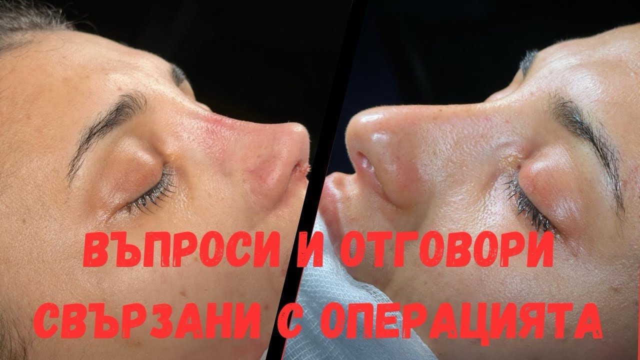 Въпроси и отговори свързани с операцията ми по ринопластика