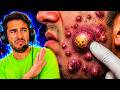Reacting to Extreme CYST & Pimple Popping Videos (SO SATISFYING)