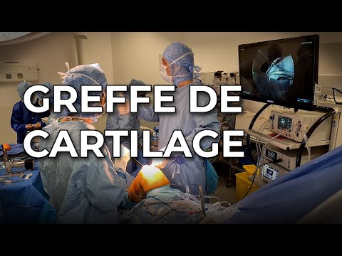 Greffe de cartilage : une nouvelle technique à partir d&rsquo;un greffon de donneur d&rsquo;organes