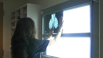 Good Health: Breast cancer over-diagnosis