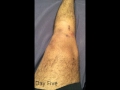 ACL Surgery Recovery - week one