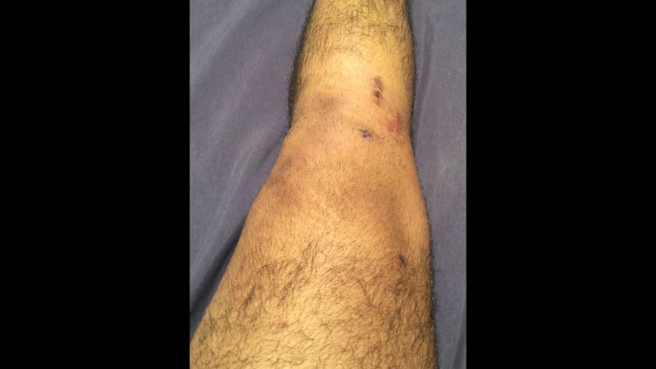 ACL Surgery Recovery week one YouTube