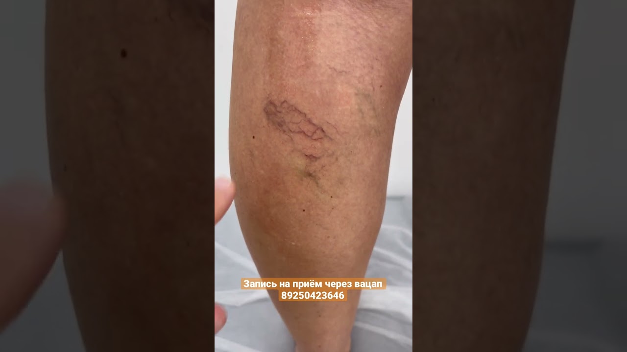 Склеротерапия, подготовка. Варикоз лечение. Узи сосудов. Лечение вен. Сосудистый хирург. Флеболог