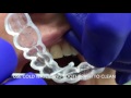 ENLIGHTEN TEETH WHITENING