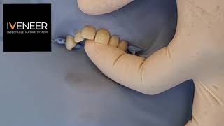 Iveneer Injectable Matrix System - Rubber Dam Isolation