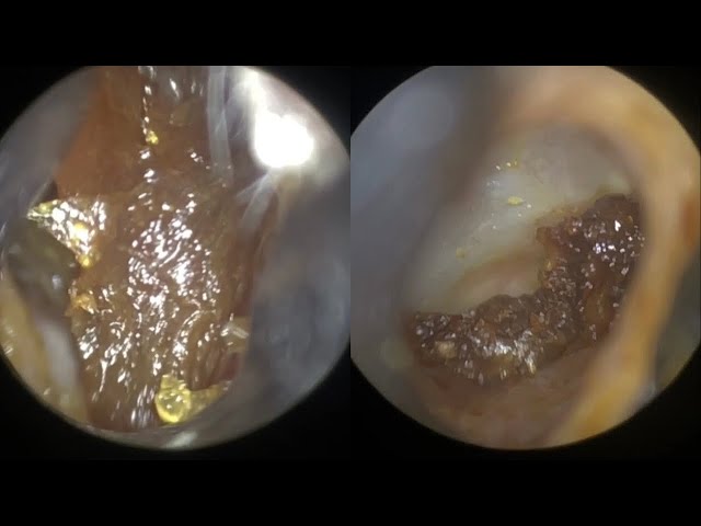 118 - Completely Blocked & Impacted Ear Wax Removal using WAXscope®️ class=