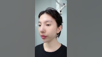 Bác sĩ Chiêm Quốc Thái sửa mũi lỗi cho khách hàng tại Bệnh viện thẩm mỹ Việt Mỹ