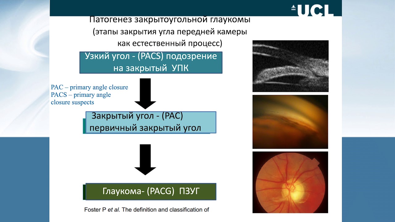 PACG: Epidemiology, prevalence and anatomical risk factors. Do we need to change the classification?