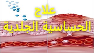 علاج الحساسية الجلدية