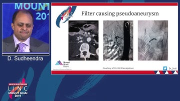 Hatch D2 - IVC Filters; Complications - Dr. Deepak Sudheendra